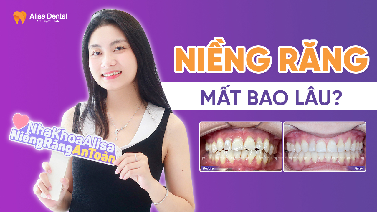 Niềng răng mất bao lâu