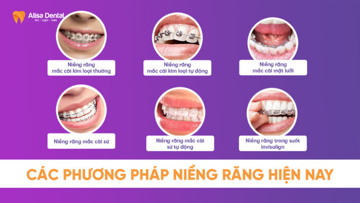 Các phương pháp niềng răng hiện nay