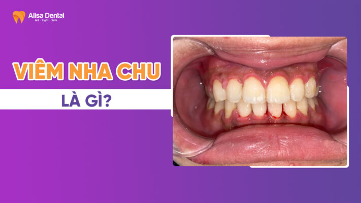 Viêm nha chu là gì