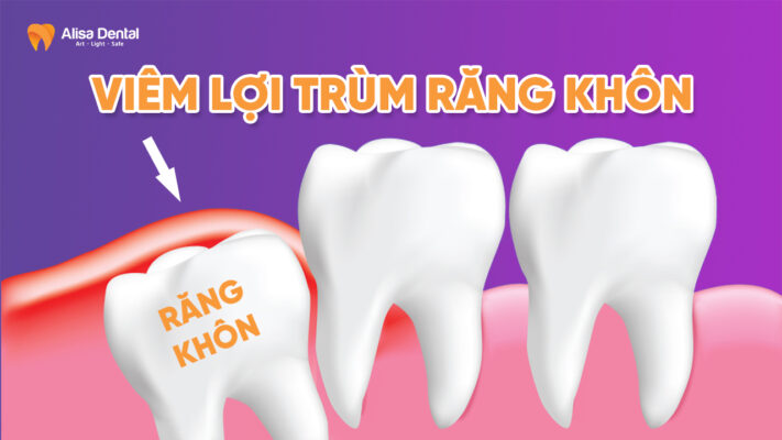 Viêm lợi trùm răng khôn