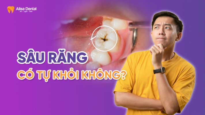Sâu răng có tự khỏi không