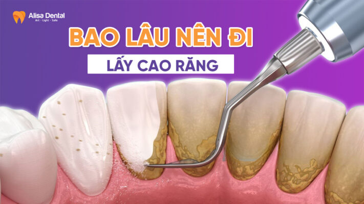 Bao lâu nên đi lấy cao răng