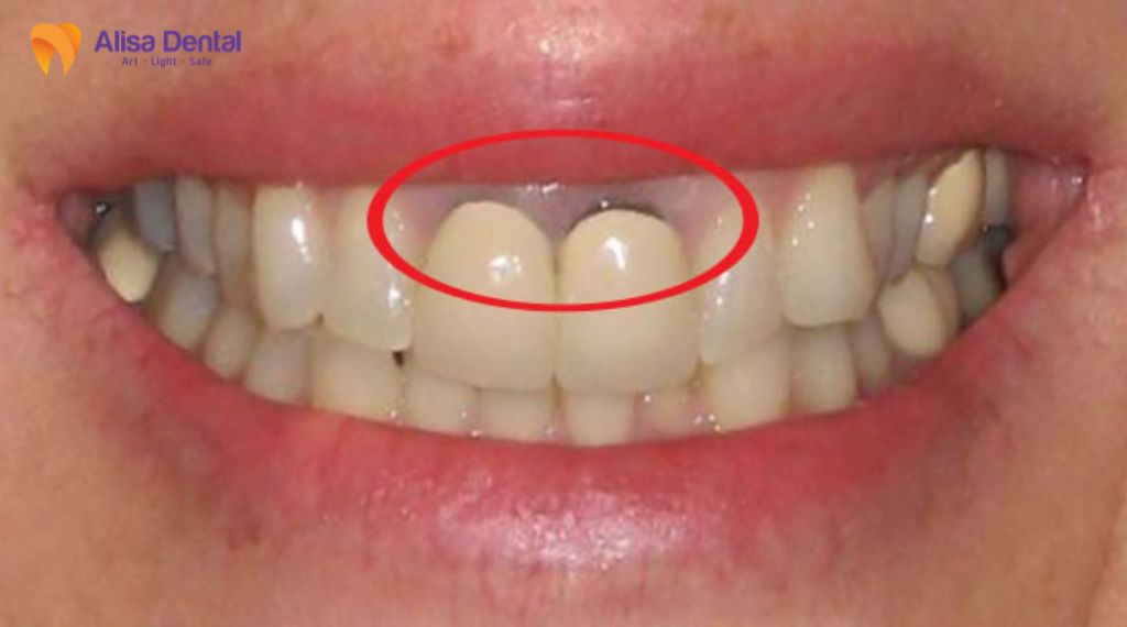 Răng sứ kim loại và răng sứ toàn sứ khác nhau thế nào