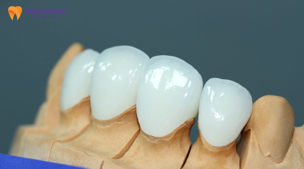 Răng sứ kim loại và răng sứ toàn sứ khác nhau thế nào