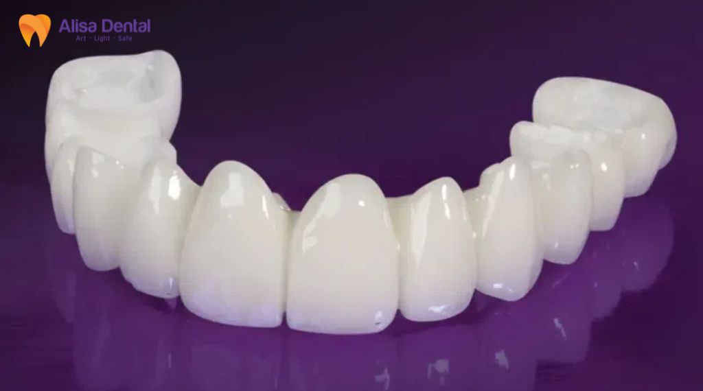 Răng sứ kim loại và răng sứ toàn sứ khác nhau thế nào