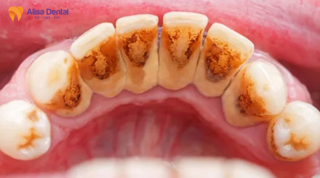 Bao lâu nên đi lấy cao răng