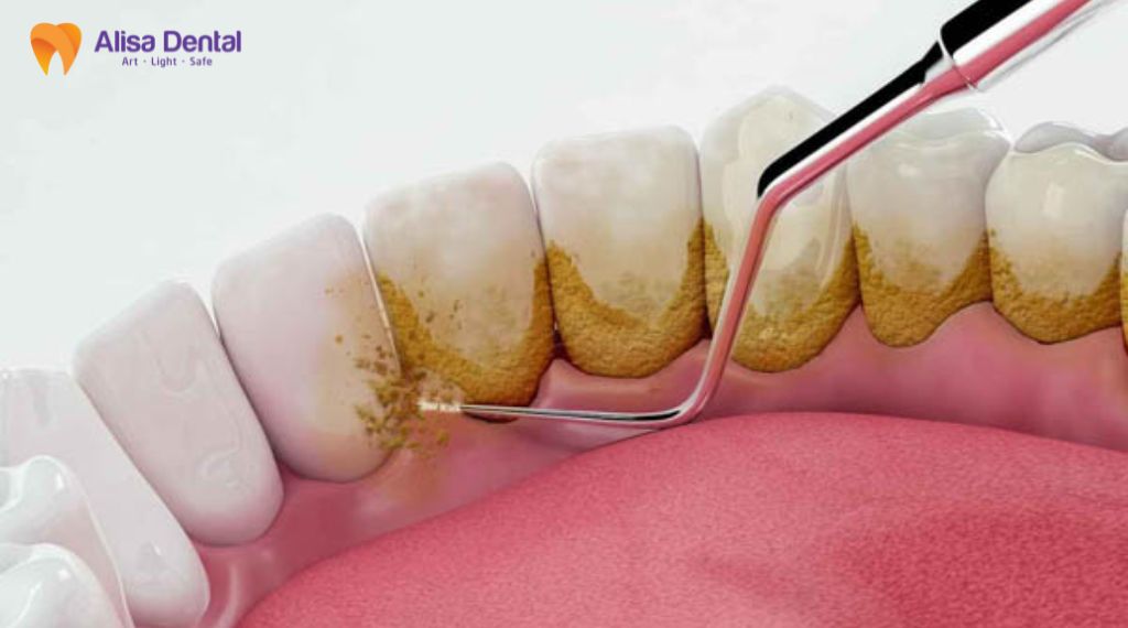 Bao lâu nên đi lấy cao răng