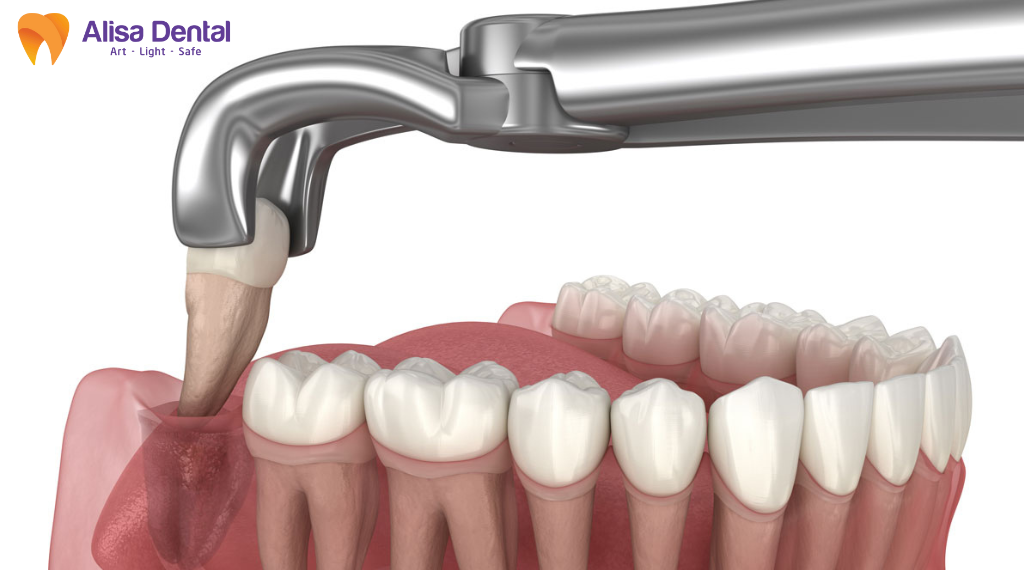 bien-chung-sau-khi-nho-rang-khon