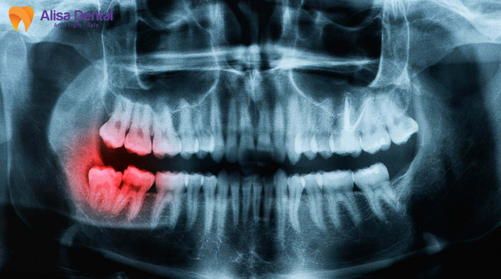 bien-chung-sau-khi-nho-rang-khon