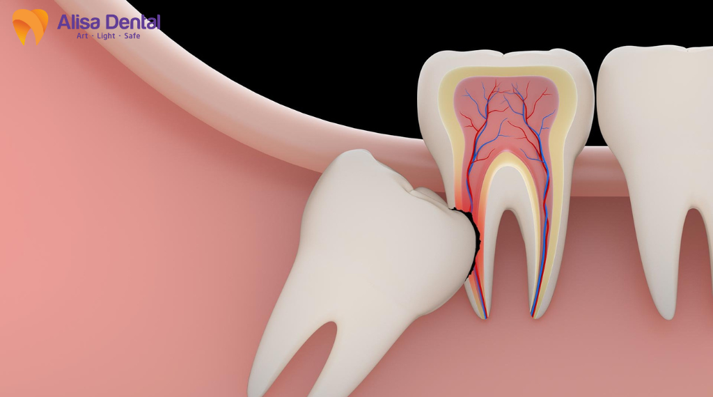 bien-chung-sau-khi-nho-rang-khon