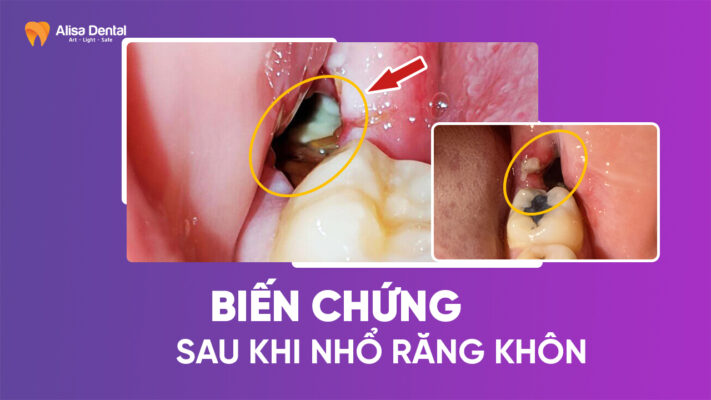 bien-chung-sau-khi-nho-rang-khon