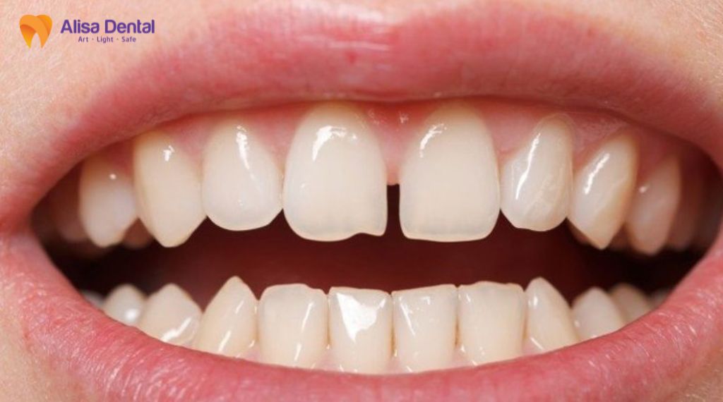 Bọc răng sứ cho răng thưa