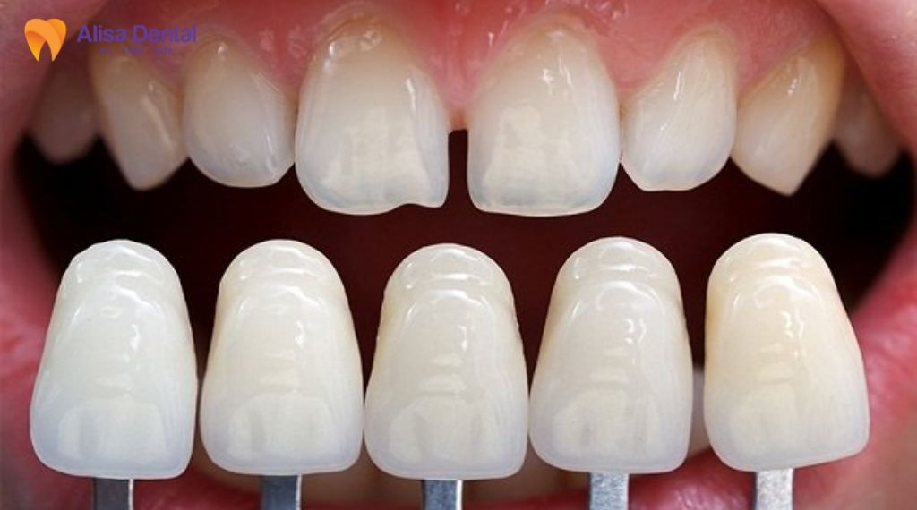 Bọc răng sứ cho răng thưa