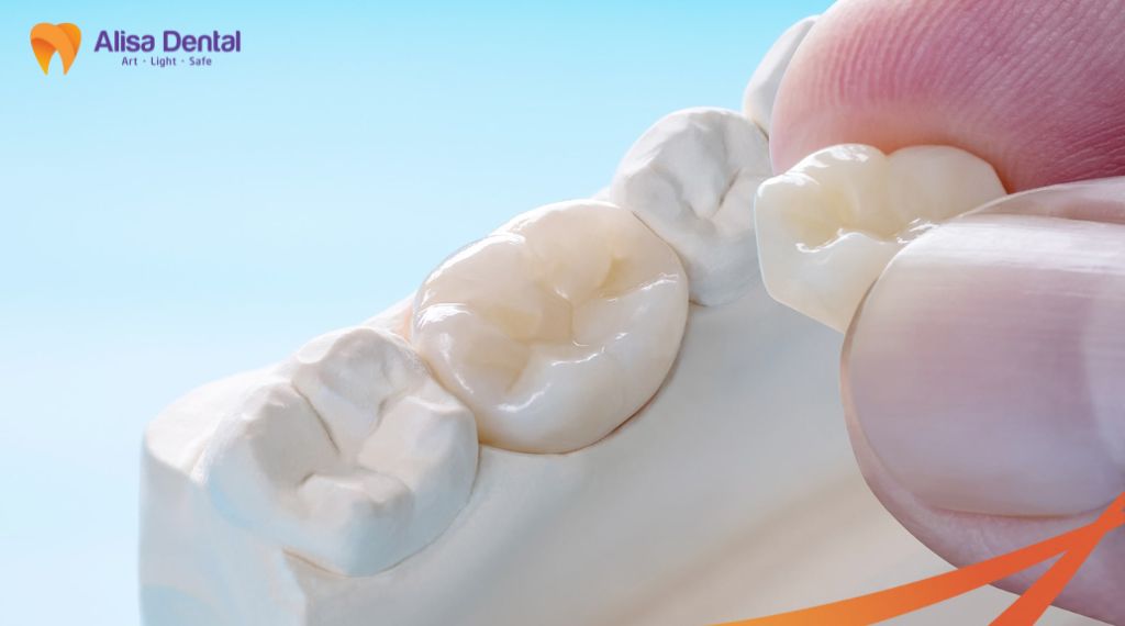 Bọc răng sứ cho răng thưa