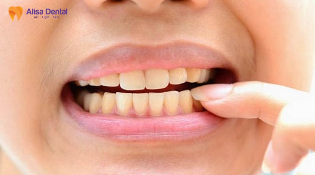 Bọc răng sứ cho răng xỉn màu