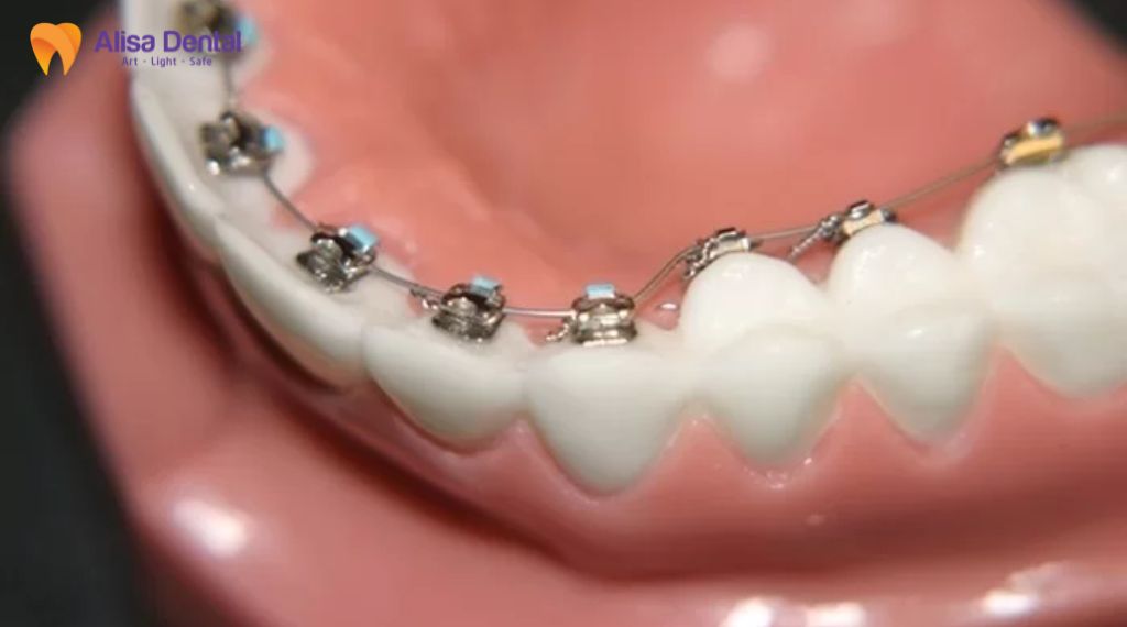 Các phương pháp niềng răng hiện nay