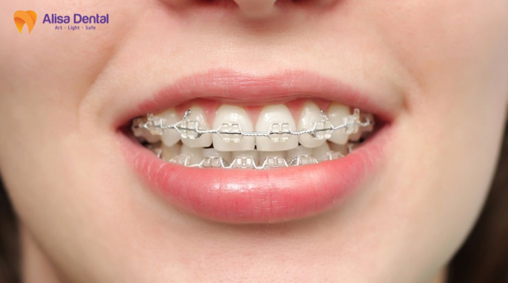 Các phương pháp niềng răng hiện nay