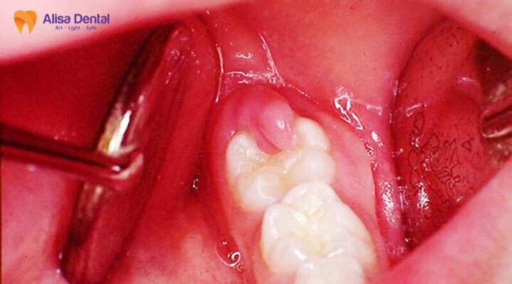 Cắt lợi trùm