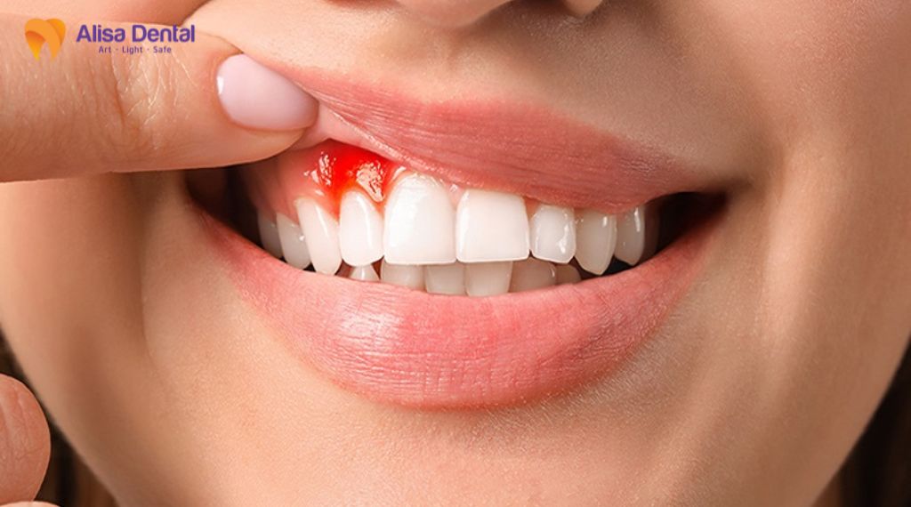 Chảy máu chân răng