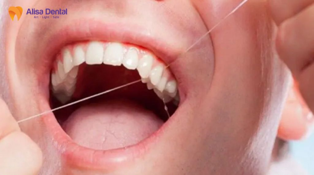 Chỉ nha khoa dùng như thế nào