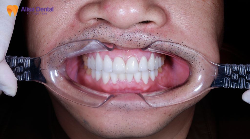 Có nên bọc răng sứ không