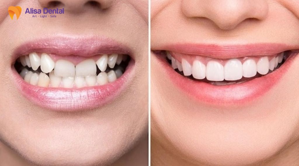 Có nên bọc răng sứ không