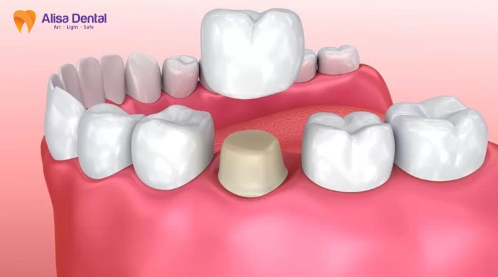 Có nên bọc răng sứ không