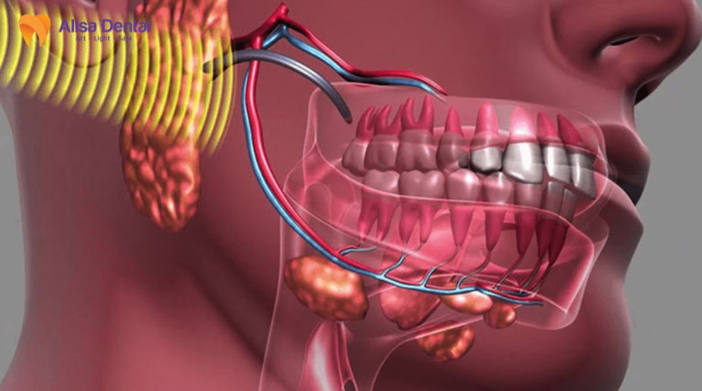 Đau một bên hàm