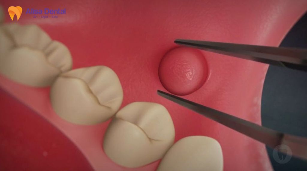 Đau một bên hàm