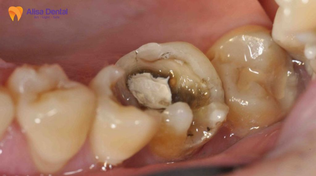 Đau một bên hàm