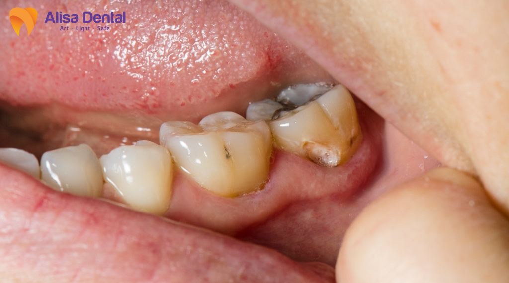 dau-rang-kieng-an-gi