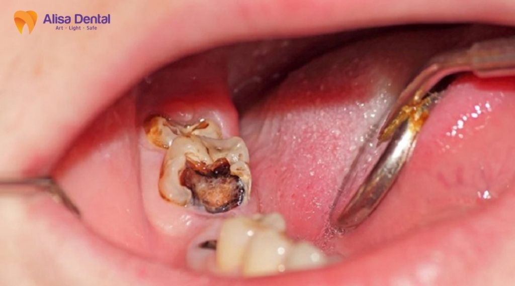 điều trị tủy răng