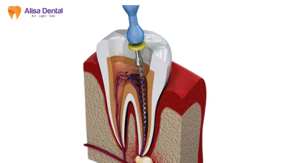 điều trị tủy răng