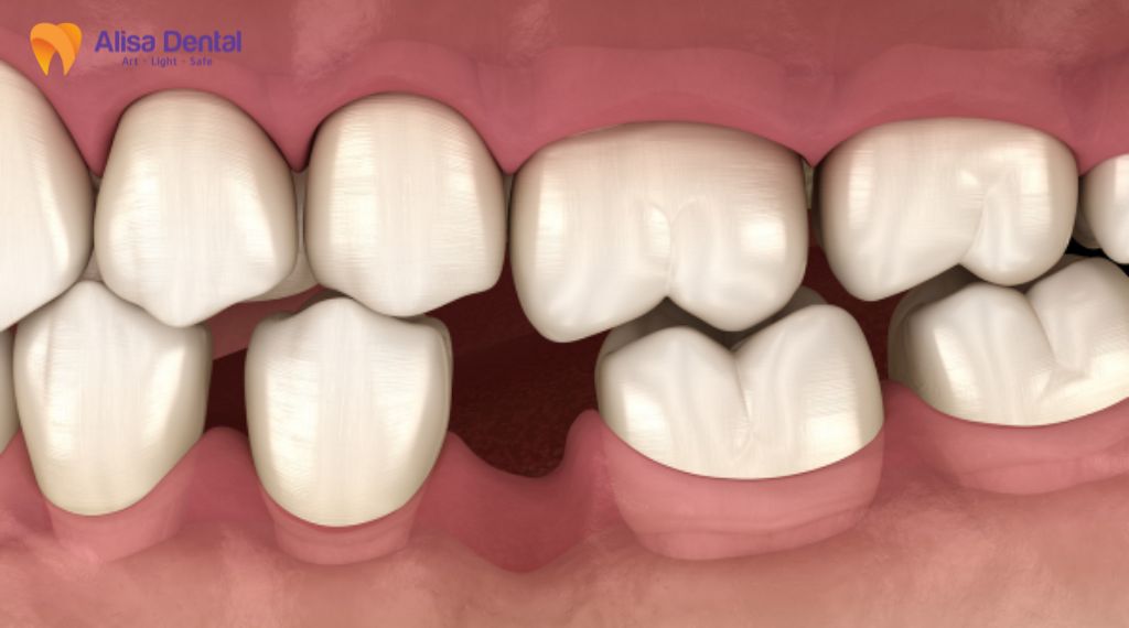 mất răng lâu năm có trồng được không