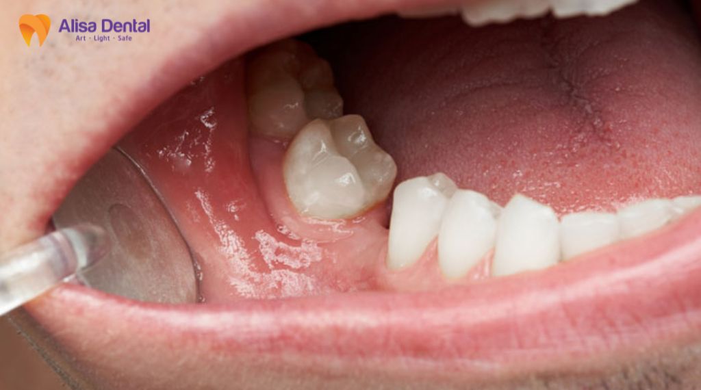 mất răng lâu năm có trồng được không