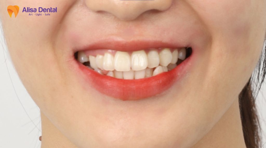 mất răng lâu năm có trồng được không