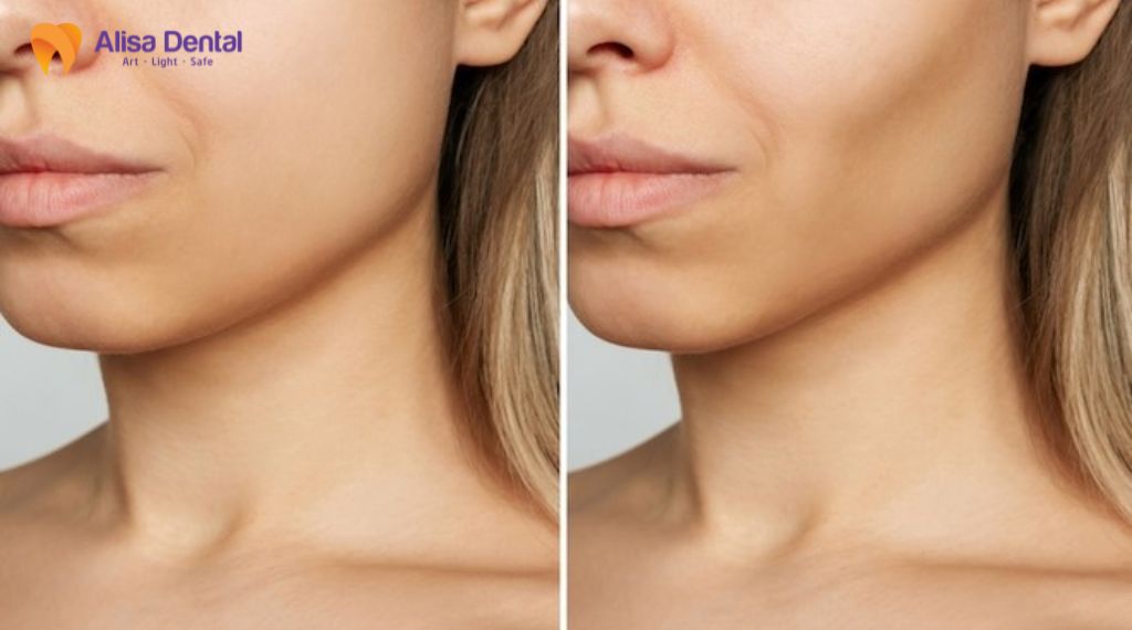 mất răng lâu năm có trồng được không