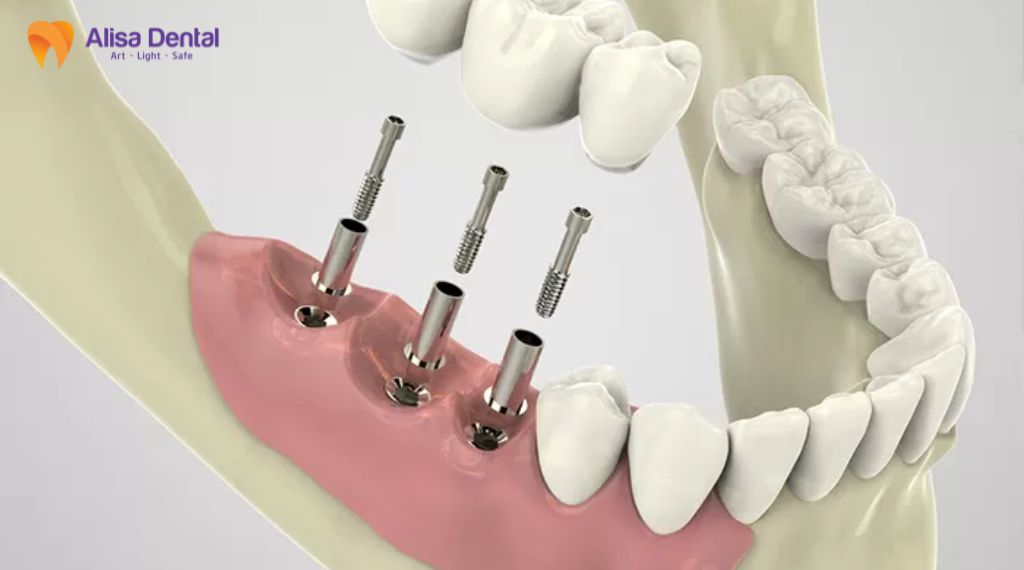 mất răng lâu năm có trồng được không