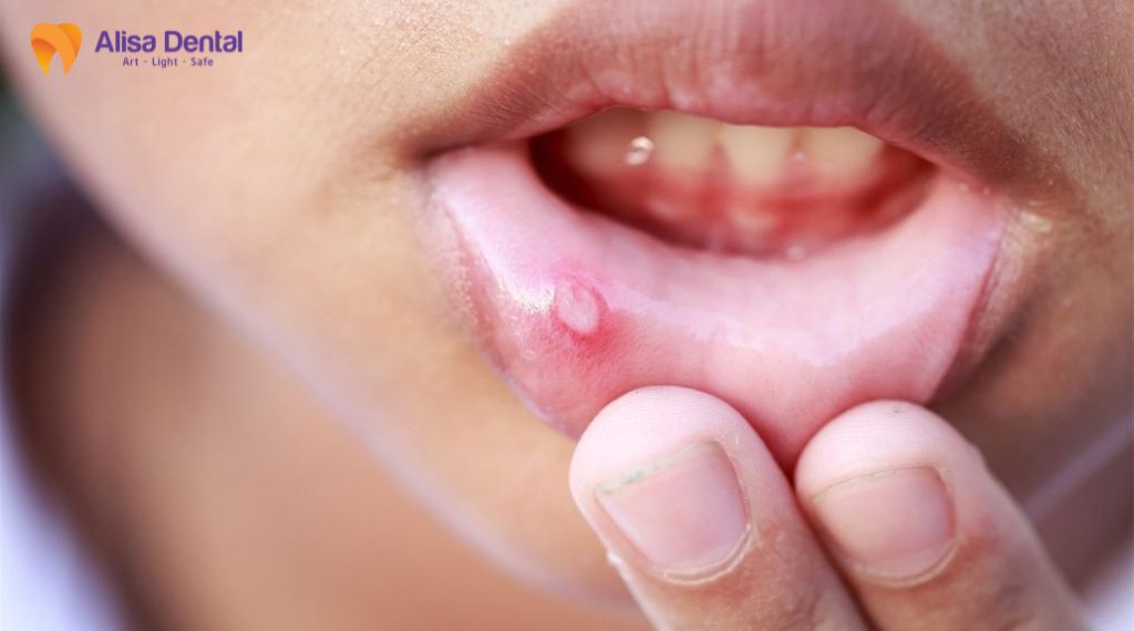 Nhiệt miệng tái phát nhiều lần