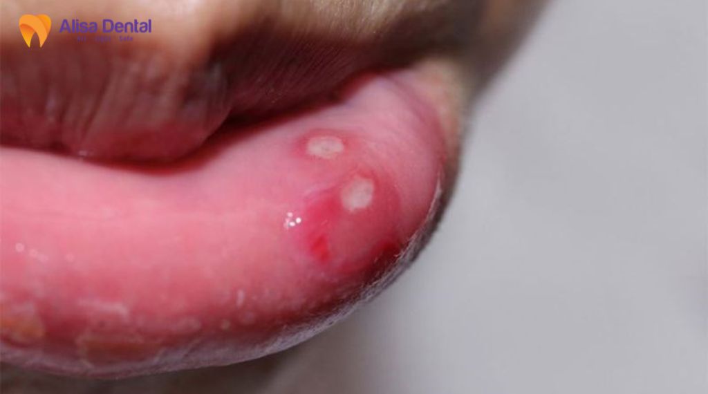 Nhiệt miệng tái phát nhiều lần