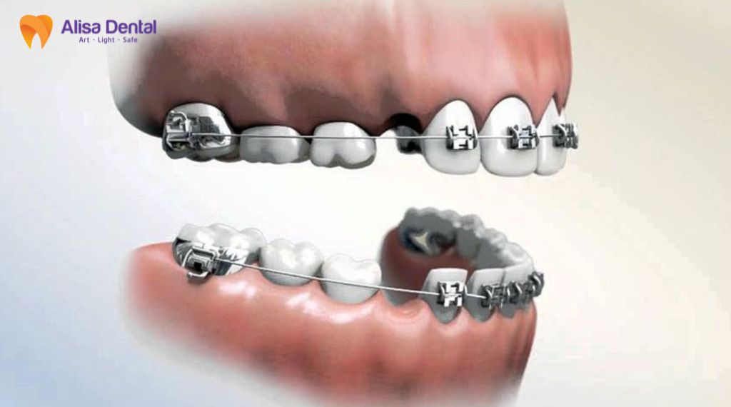 Niềng răng có cần nhổ răng không