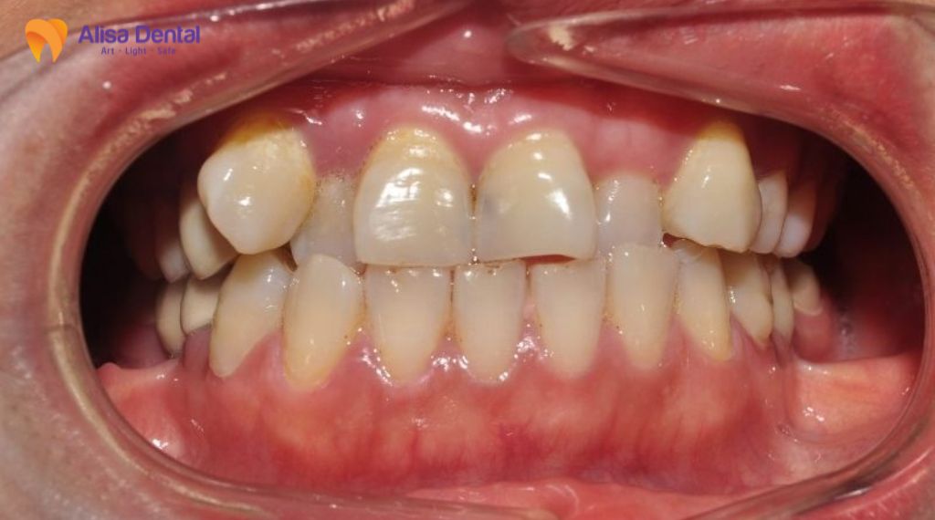 Niềng răng có cần nhổ răng không