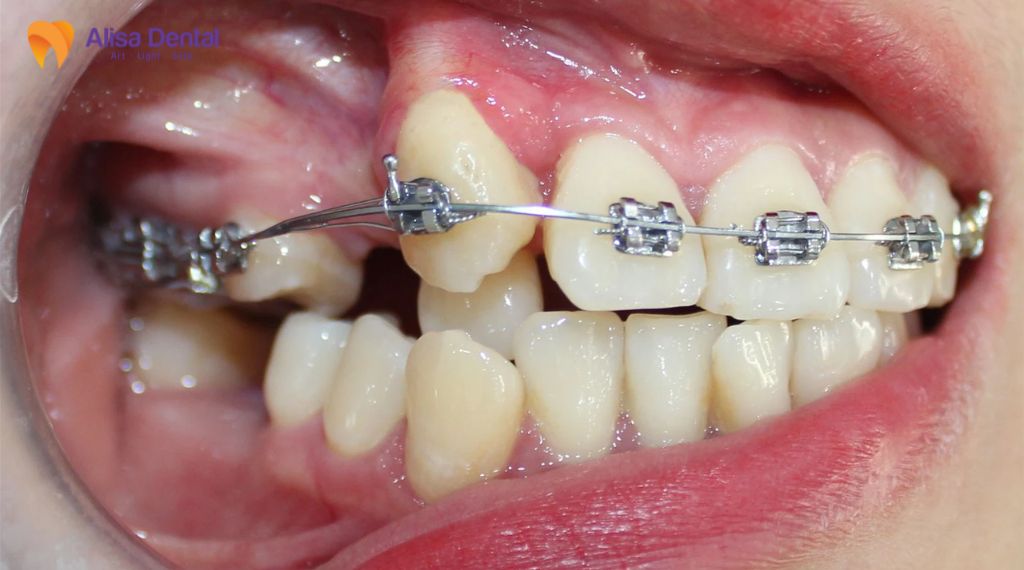 Niềng răng có cần nhổ răng không