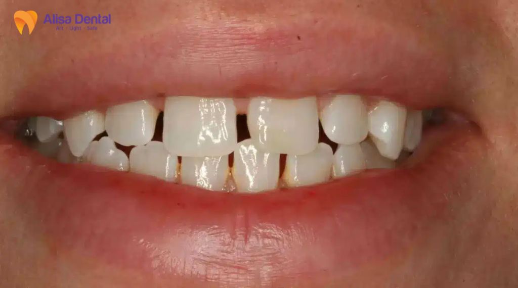 Niềng răng có cần nhổ răng không