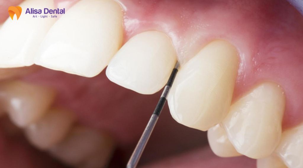 Niềng răng có cần nhổ răng không