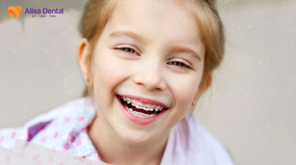 Niềng răng mất bao lâu