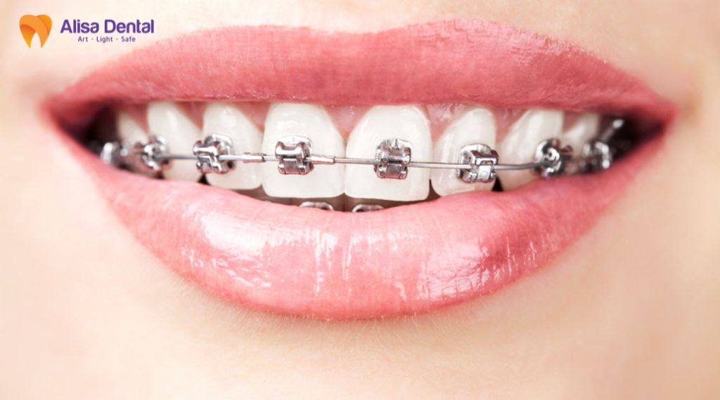 Niềng răng mất bao lâu