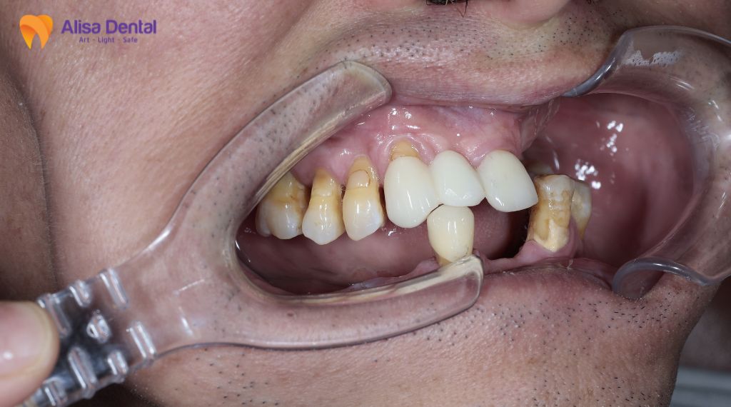 Niềng răng mất bao lâu