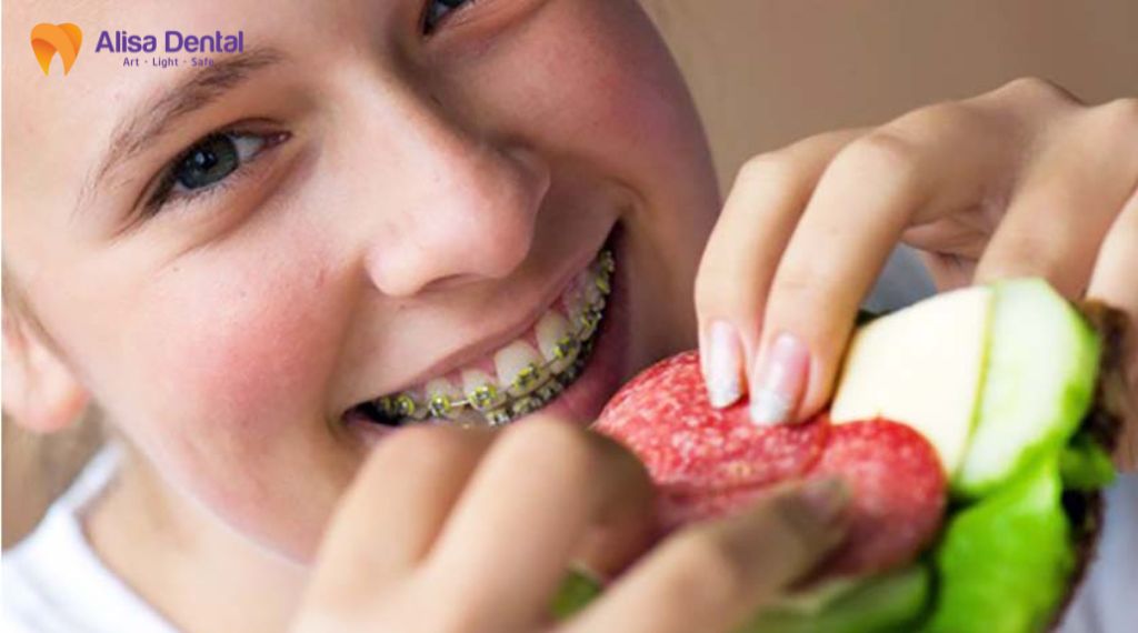 Niềng răng mất bao lâu