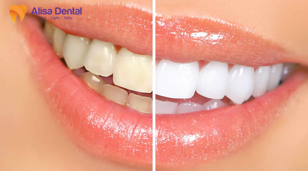 phuong-phap-tay-trang-rang-hien-nay